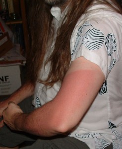 BurnLine First sunburn of the year
